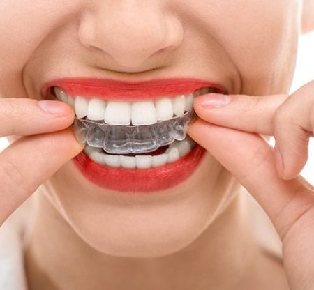 Clear Aligners